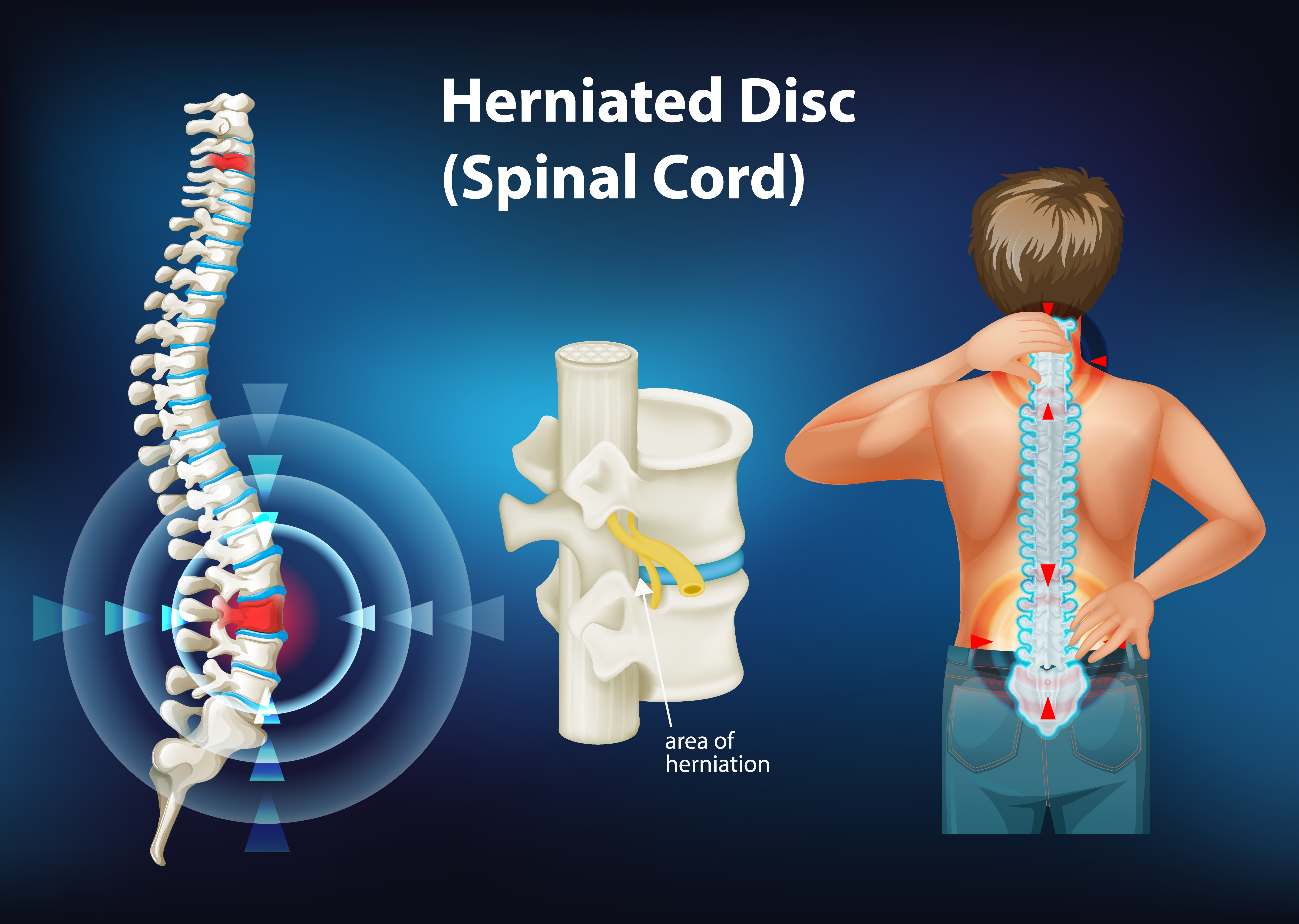Ankylosing Spondylitis